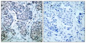 Immunohistochemical analysis of paraffin-embedded human breast carcinoma using Anti-SEK1 (phospho Thr261) Antibody. The right hand panel represents a negative control, where the antibody was pre-incubated with the immunising peptide