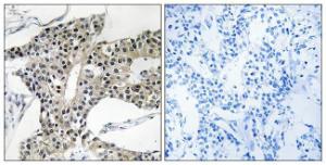 Immunohistochemical analysis of paraffin-embedded human breast carcinoma tissue using Anti-ARSK Antibody. The right hand panel represents a negative control, where the antibody was pre-incubated with the immunising peptide.