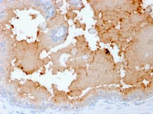 Immunohistochemical analysis of formalin-fixed, paraffin-embedded human prostate carcinoma using Anti-AKT1 Antibody [rAKT1/2491]