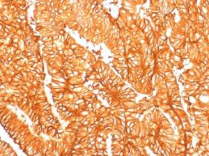 Immunohistochemical analysis of formalin-fixed, paraffin-embedded human colon carcinoma using Anti-EpCAM Antibody [EGP40/1556R]