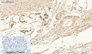 Immunohistochemical analysis of paraffin-embedded human stomach cancer tissue using Anti-Ki67 Antibody at 1:200 (4°C overnight). Negative control was secondary antibody only.