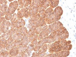 Immunohistochemical analysis of formalin-fixed, paraffin-embedded human basal cell carcinoma using Anti-EpCAM Antibody [EGP40/2041R]