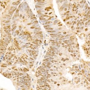 Immunohistochemistry analysis of paraffin-embedded human colon carcinoma tissue using Anti-POLD3 Antibody (A10090) at a dilution of 1:300 (40x lens) Perform microwave antigen retrieval with 10 mM PBS buffer pH 72 before commencing with IHC staining protocol