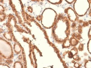 Immunohistochemical analysis of formalin-fixed, paraffin-embedded human thyroid carcinoma using Anti-EpCAM Antibody [EGP40/2041R]