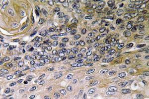 Immunohistochemical analysis of paraffin-embedded human lung carcinoma tissue using Anti-IL-8 Antibody