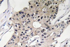 Immunohistochemical analysis of paraffin-embedded human breast carcinoma tissue using Anti-Defensin alpha1 Antibody