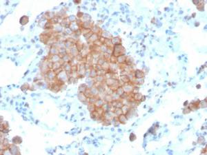 Immunohistochemical analysis of formalin-fixed, paraffin-embedded human lung carcinoma using Anti-CD86 Antibody [C86/3711]