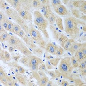 Immunohistochemistry analysis of paraffin-embedded human liver cancer using Anti-FLR Antibody (A10093) at a dilution of 1:100 (40x lens)