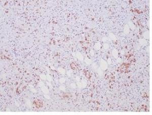 Immunohistochemical analysis of formalin-fixed, paraffin-embedded human anaplastic large cell lymphoma tissue using Anti-ALK Antibody [ALK1/7008R]