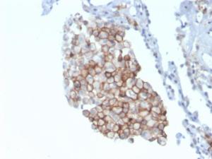 Immunohistochemical analysis of formalin-fixed, paraffin-embedded human lung carcinoma using Anti-CD86 Antibody [C86/3711]