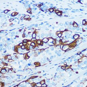 Immunohistochemistry analysis of paraffin-embedded human esophageal cancer using Anti-Cytokeratin 5 Antibody [ARC0585] (A80808) at a dilution of 1:100 (40x lens) Perform microwave antigen retrieval with 10 mM PBS buffer pH 72 before commencing with IHC staining protocol