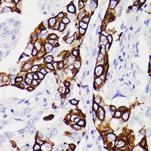 Immunohistochemistry analysis of paraffin-embedded human lung squamous carcinoma tissue using Anti-Cytokeratin 5 Antibody [ARC0585] (A80808) at a dilution of 1:100 (40x lens) Perform microwave antigen retrieval with 10 mM PBS buffer pH 72 before commencing with IHC staining protocol