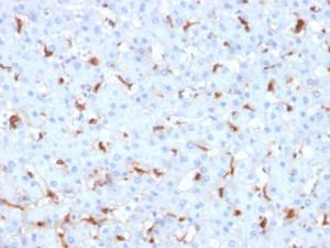 Immunohistochemical analysis of formalin-fixed, paraffin-embedded human hepatocellular carcinoma using Anti-C1QB Antibody [C1QB/2961]