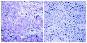 Immunohistochemical analysis of paraffin-embedded human breast carcinoma using Anti-PDK1 (phospho Ser241) Antibody The right hand panel represents a negative control, where the antibody was pre-incubated with the immunising peptide