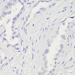 Immunohistochemistry analysis of paraffin-embedded human lung adenocarcinoma (negative control sample) using Anti-Cytokeratin 5 Antibody [ARC0585] (A80808) at a dilution of 1:100 (40x lens) Perform microwave antigen retrieval with 10 mM PBS buffer pH 72 before commencing with IHC staining protocol