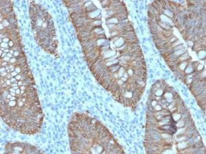 Immunohistochemical analysis of formalin-fixed, paraffin-embedded human colon carcinoma using Anti-EpCAM Antibody [EGP40/2571R]