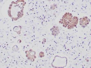 Immunohistochemical analysis of formalin-fixed, paraffin-embedded human lung adenocarcinoma tissue using Anti-ALK Antibody [ALK1/6698R] at 2µg/ml