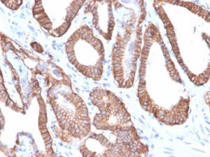 Immunohistochemical analysis of formalin-fixed, paraffin-embedded human prostate carcinoma using Anti-EpCAM Antibody [EGP40/2571R]