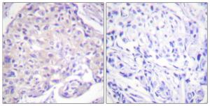 Immunohistochemical analysis of paraffin-embedded human breast carcinoma using Anti-PAK1 (phospho Thr212) Antibody. The right hand panel represents a negative control, where the Antibody was pre-incubated with the immunising peptide