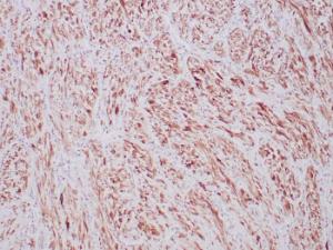 Immunohistochemical analysis of formalin-fixed, paraffin-embedded human inflammatory myofibroblastic tumor tissue using Anti-ALK Antibody [ALK1/6698R] at 2µg/ml