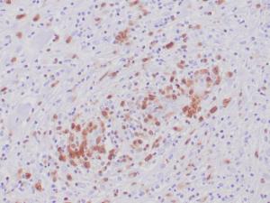 Immunohistochemical analysis of formalin-fixed, paraffin-embedded human anaplastic large cell lymphoma tissue using Anti-ALK Antibody [ALK1/6698R] at 2µg/ml