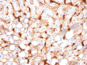 Immunohistochemical analysis of formalin-fixed, paraffin-embedded human hepatocellular carcinoma using Anti-C1QB Antibody [C1QB/2966]