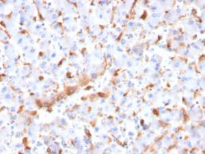 Immunohistochemical analysis of formalin-fixed, paraffin-embedded human hepatocellular carcinoma using Anti-C1QB Antibody [C1QB/2966]