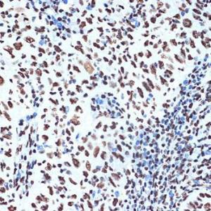 Immunohistochemistry analysis of paraffin-embedded human esophageal cancer using Anti-SET/TAF-I Antibody [ARC1462] (A305799) at a dilution of 1:100 (40X lens). Perform microwave antigen retrieval with 10 mM Tris/EDTA buffer pH 9.0 before commencing with IHC staining protocol