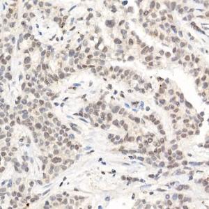 Immunohistochemistry analysis of paraffin-embedded human breast cancer tissue using Anti-L3MBTL3 Antibody (A10103) at a dilution of 1:50 (40x lens) Perform high pressure antigen retrieval with 10 mM citrate buffer pH 60 before commencing with IHC staining protocol