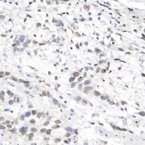 Immunohistochemistry analysis of paraffin-embedded human esophageal cancer using Anti-L3MBTL3 Antibody (A10103) at a dilution of 1:50 (40x lens) Perform high pressure antigen retrieval with 10 mM citrate buffer pH 60 before commencing with IHC staining protocol