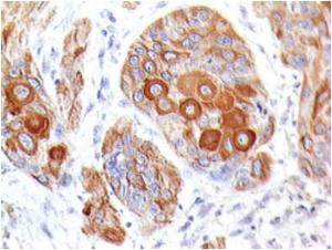 Immunohistochemical analysis of formalin-fixed, paraffin-embedded human esophageal tumor using Anti-CD86 Antibody [BU63]