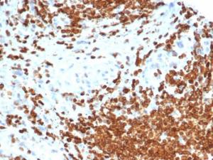 Immunohistochemical analysis of formalin-fixed, paraffin-embedded human bladder carcinoma using Anti-AMH Antibody [AMH/6713R] at 2µg/ml in PBS for 30 minutes at room temperature