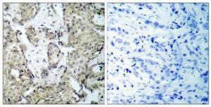 Immunohistochemical analysis of paraffin-embedded human breast carcinoma using Anti-MKK6 (phospho Ser207) Antibody. The right hand panel represents a negative control, where the Antibody was pre-incubated with the immunising peptide