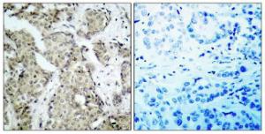 Immunohistochemical analysis of paraffin-embedded human breast carcinoma using Anti-MKK3 (phospho Ser189) Antibody The right hand panel represents a negative control, where the antibody was pre-incubated with the immunising peptide