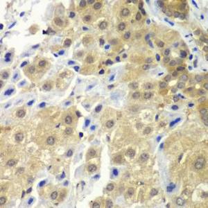 Immunohistochemistry of paraffin-embedded human liver cancer using Anti-SGTA Antibody (A7306) at dilution of 1:100 (40x lens)