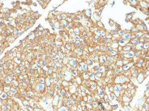 Immunohistochemical analysis of formalin-fixed, paraffin-embedded human renal cell carcinoma using Anti-EpCAM Antibody