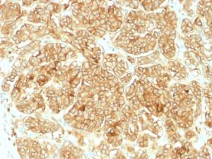 Immunohistochemical analysis of formalin-fixed, paraffin-embedded human renal cell carcinoma using Anti-EpCAM Antibody