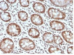 Immunohistochemical analysis of formalin-fixed, paraffin-embedded human colon tissue using Anti-MSH6 Antibody [MSH6/4592R]