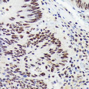 Immunohistochemistry analysis of paraffin-embedded human colon carcinoma tissue using Anti-RNF40 Antibody [ARC1651] (A308431) at a dilution of 1:100 (40x lens)