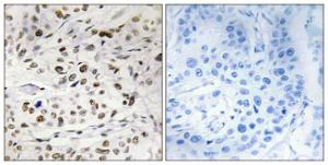 Immunohistochemical analysis of paraffin-embedded human breast carcinoma using Anti-HMG14 (phospho Ser21) Antibody. The right hand panel represents a negative control, where the antibody was pre-incubated with the immunising peptide