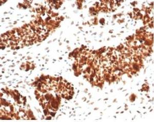 Immunohistochemical analysis of formalin-fixed, paraffin-embedded human ovarian carcinoma tissue using Anti-MSH6 Antibody [MSH6/7065R]