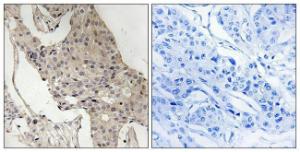 Immunohistochemical analysis of paraffin-embedded human breast carcinoma using Anti-Gab2 (phospho Ser623) Antibody. The right hand panel represents a negative control, where the Antibody was pre-incubated with the immunising peptide