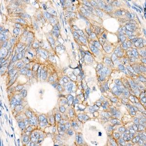 Immunohistochemistry analysis of paraffin-embedded human colon carcinoma tissue using Anti-MRP1 Antibody [ARC52207] (A305805) at a dilution of 1:100(40x lens)