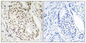 Immunohistochemical analysis of paraffin-embedded human breast carcinoma tissue using Anti-HNRNPUL2 Antibody. The right hand panel represents a negative control, where the antibody was pre-incubated with the immunising peptide