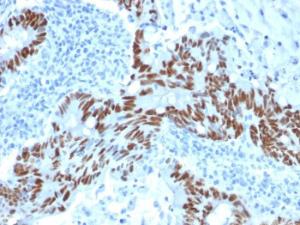 Immunohistochemical analysis of formalin-fixed, paraffin-embedded human colon carcinoma using Anti-p53 Antibody [PCRP-TP53-1F7]