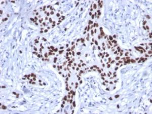 Immunohistochemical analysis of formalin-fixed, paraffin-embedded human breast carcinoma using Anti-p53 Antibody [rTP53/1739]