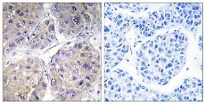 Immunohistochemical analysis of paraffin-embedded human liver carcinoma tissue using Anti-SLC27A5 Antibody The right hand panel represents a negative control, where the antibody was pre-incubated with the immunising peptide