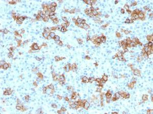 Immunohistochemical analysis of formalin-fixed, paraffin-embedded human Hodgkin's lymphoma using Anti-CD30 Antibody [Ki-1/779]