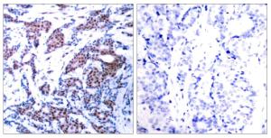 Immunohistochemical analysis of paraffin-embedded human breast carcinoma using Anti-c-Jun (phospho Ser73) Antibody. The right hand panel represents a negative control, where the antibody was pre-incubated with the immunising peptide