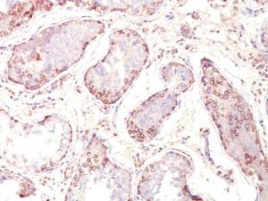 Immunohistochemical analysis of formalin-fixed, paraffin-embedded human testicular carcinoma using Anti-MAGE 1 Antibody [MZ2E/838]